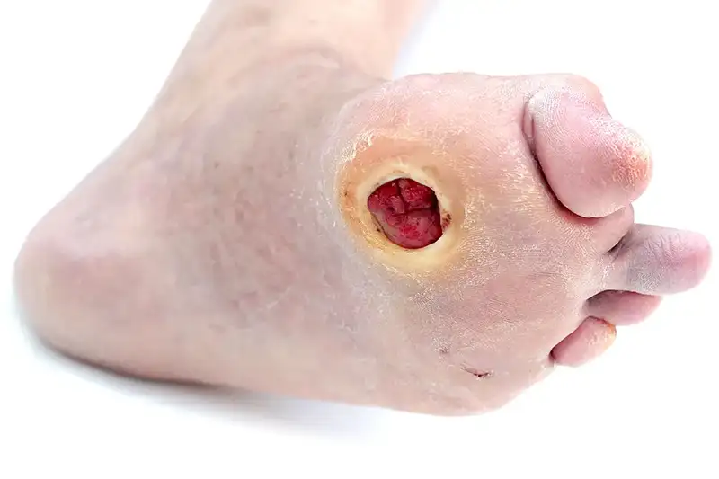 Diabetic Foot Ulcer