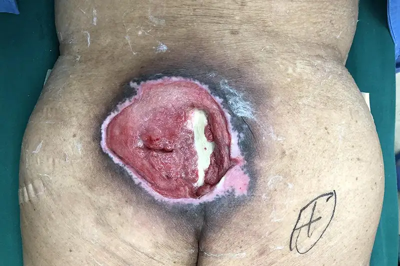 Stage 4 Sacral Pressure Ulceer