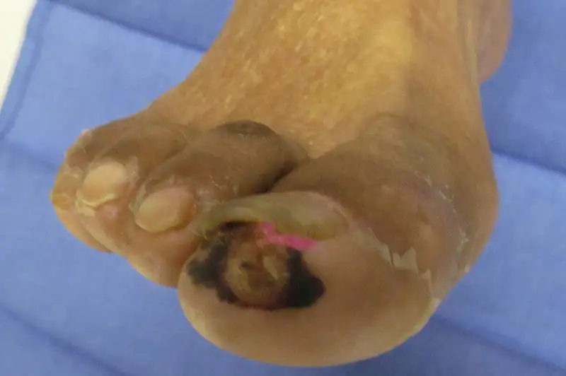 Arterial Ulcer