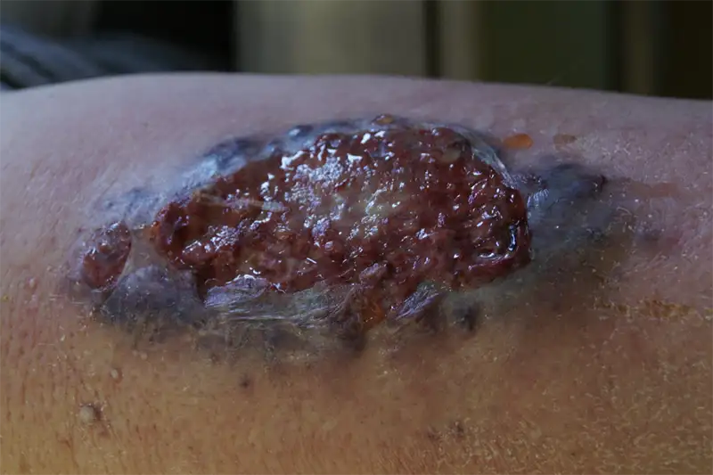 Atypical Wound -Pyoderma Gangrenosum Ulcer