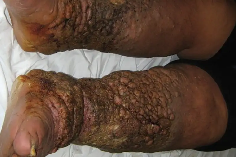 Lymphostatic Elephantiasis