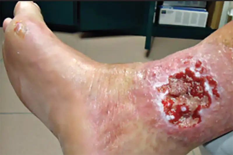 Venous Stasis Ulcer