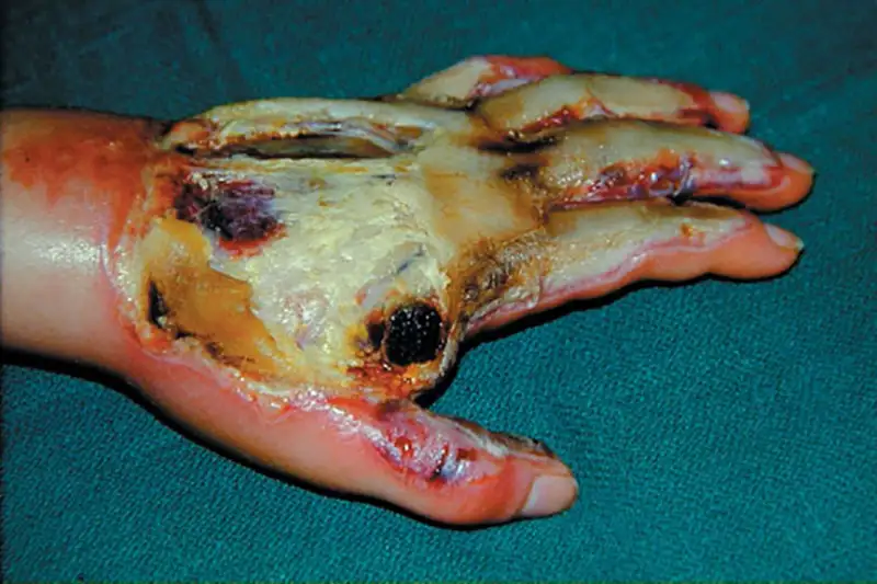 3rd degree or full thickness burn of left hand