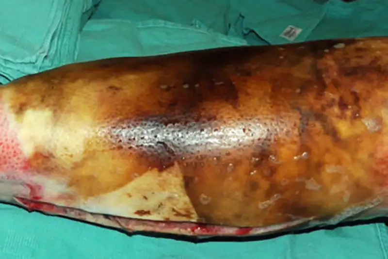 3rd degree or full thickness burn of leg